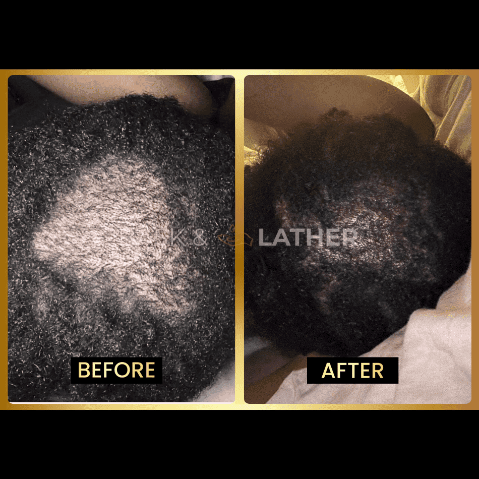 scalp-stimulator-3-month-supply - Bask And Lather Store