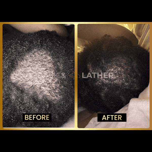 Scalp Stimulator- 3 Month Supply