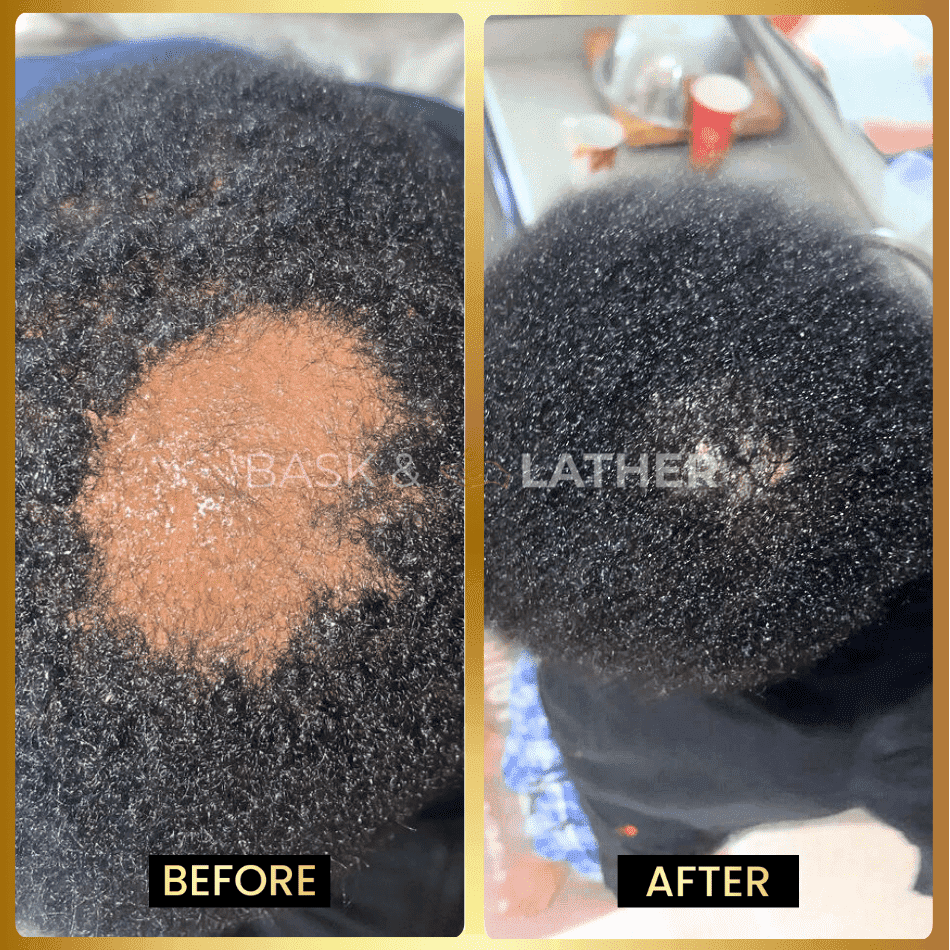 scalp-stimulator-3-month-supply - Bask And Lather Store